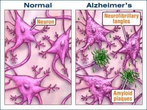 Grovigli e placche di Alzheimer